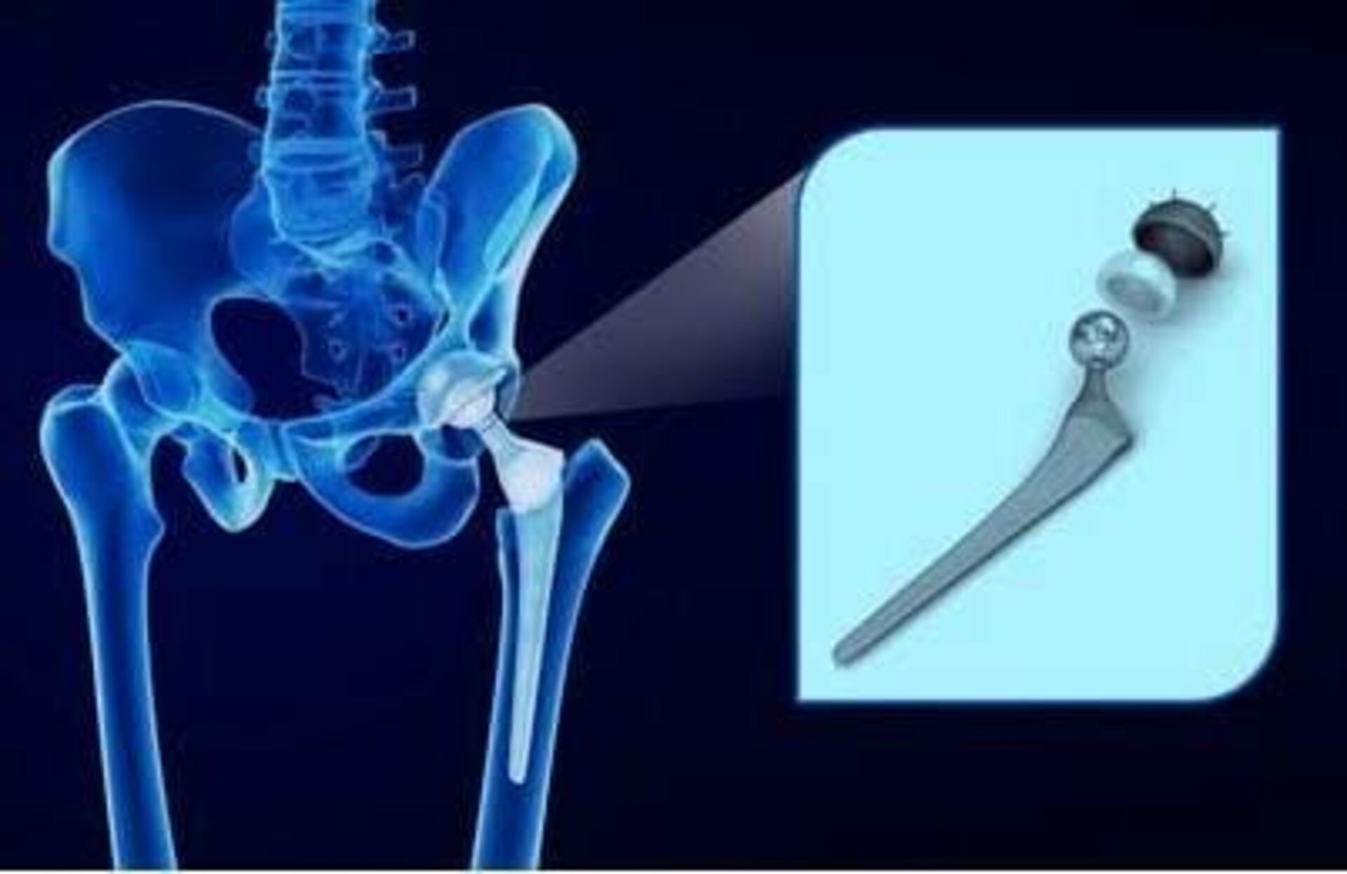 Total Hip Replacement (THR)