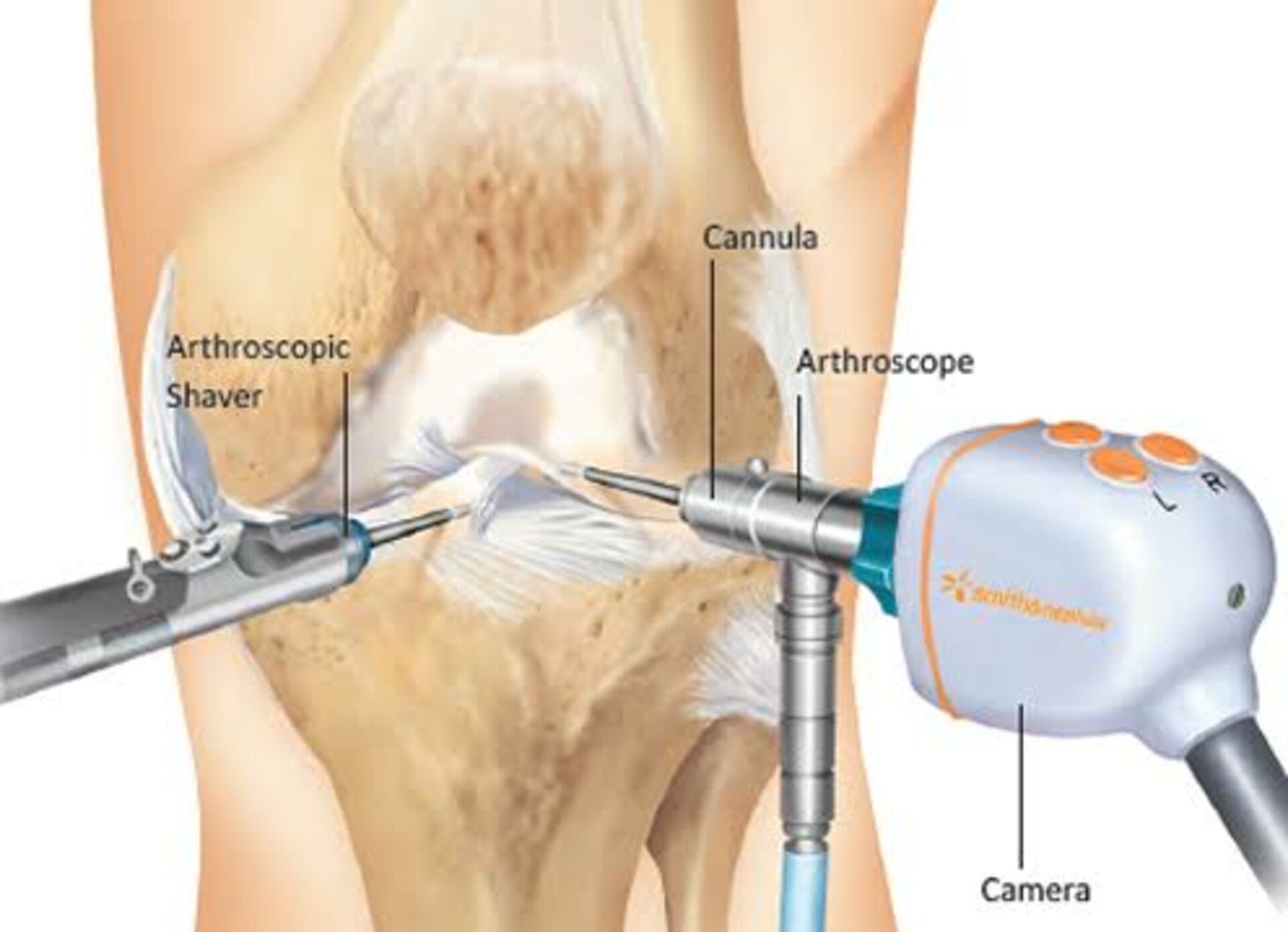 Arthroscopic Knee Surgery