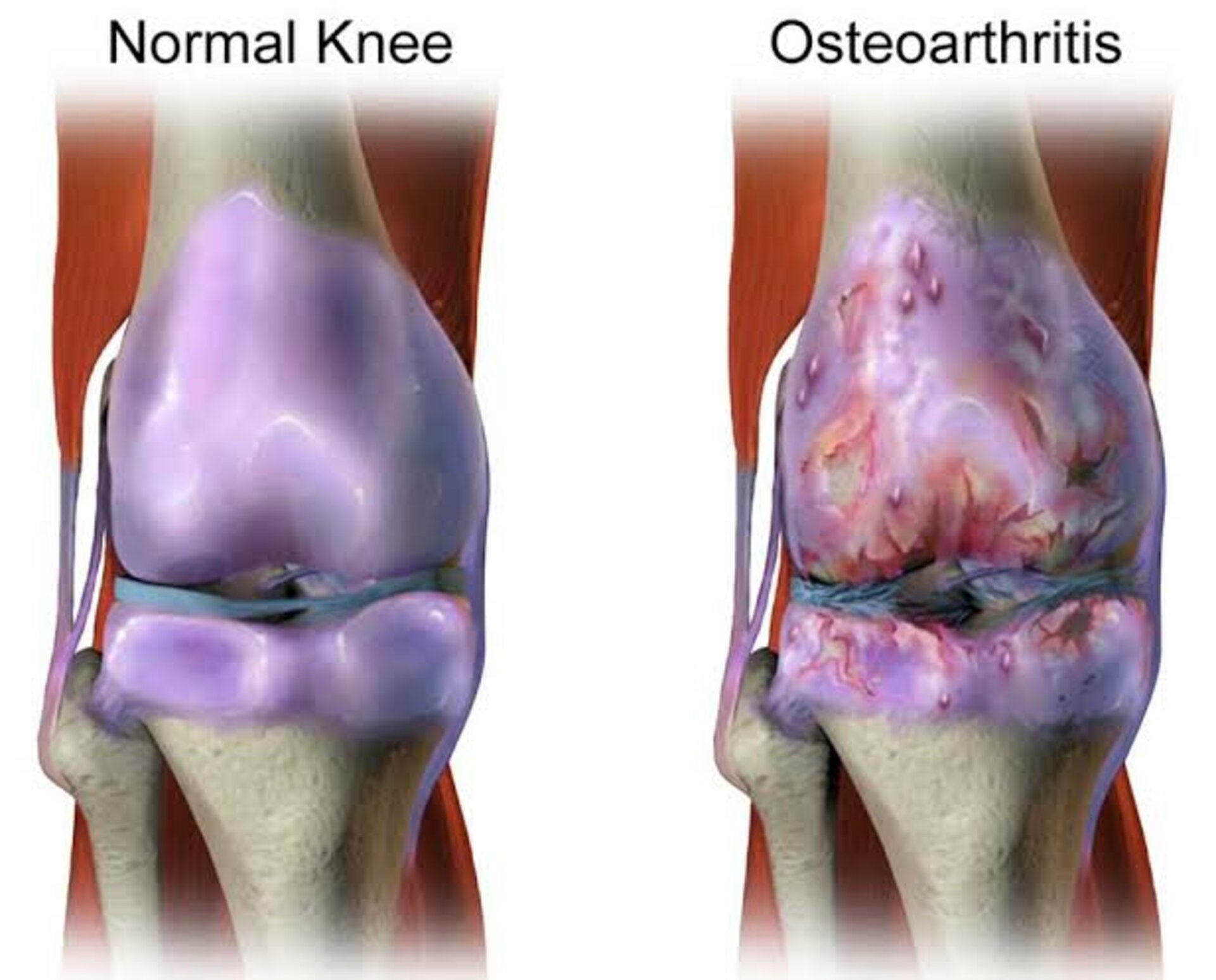 Osteoarthritis Management
