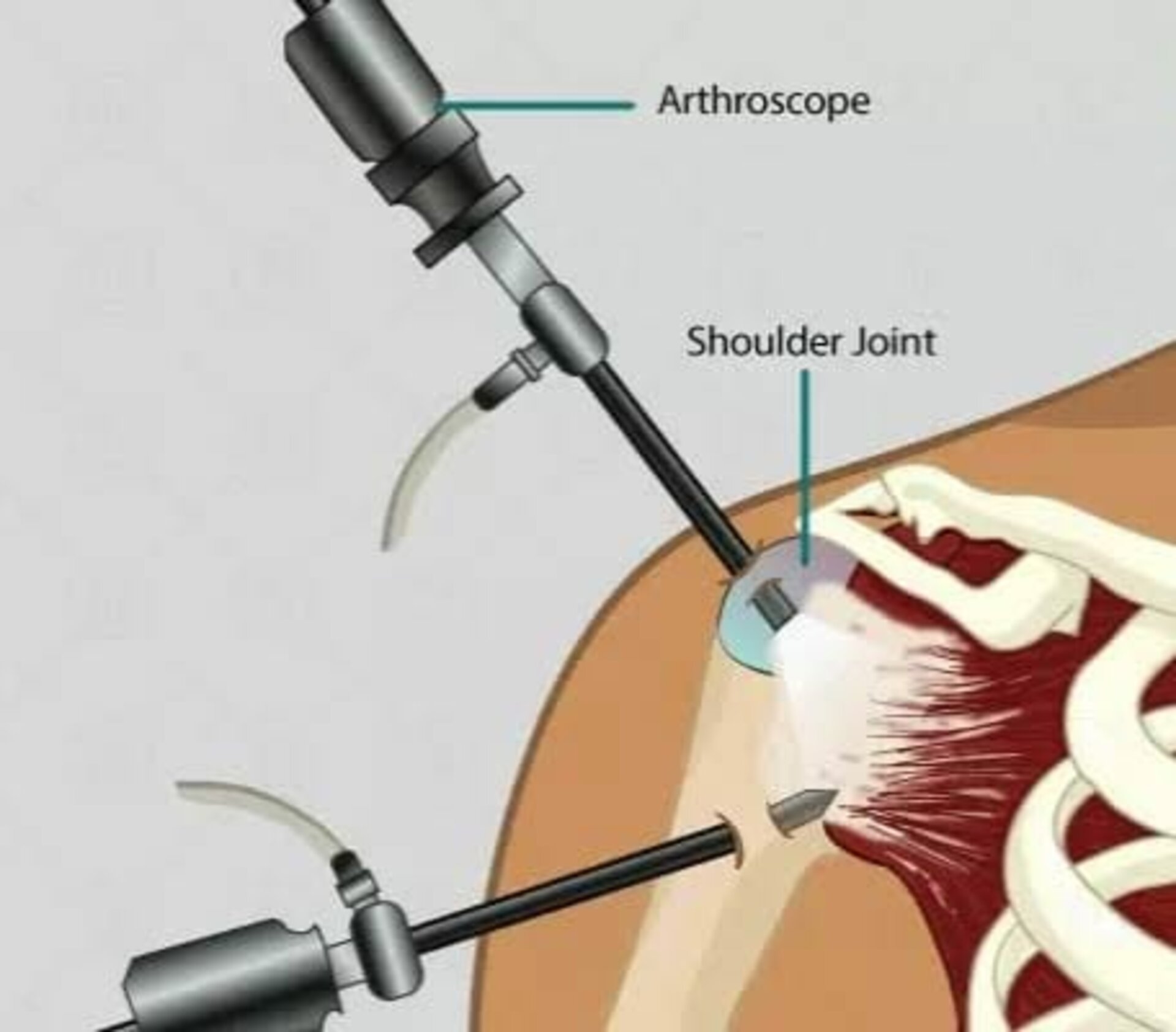 Arthroscopic Shoulder Surgery